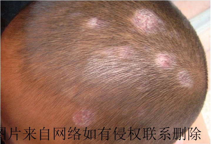 儿童白癜风有什么症状