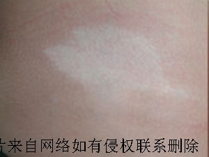 春冬季白癜风发病率为何高