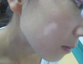 爱美人士遇到白斑的恐吓