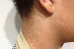  男人有了白癜风该怎么办