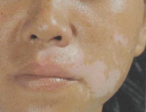  感冒也会诱发白癜风吗