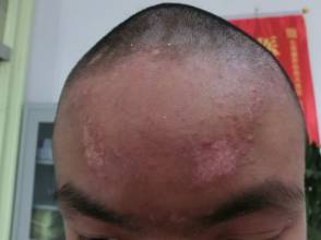头部白癜风怎么护理